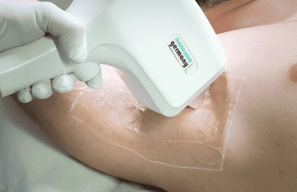 Laserbehandlung mit dem SHR-germany Diodenlaser