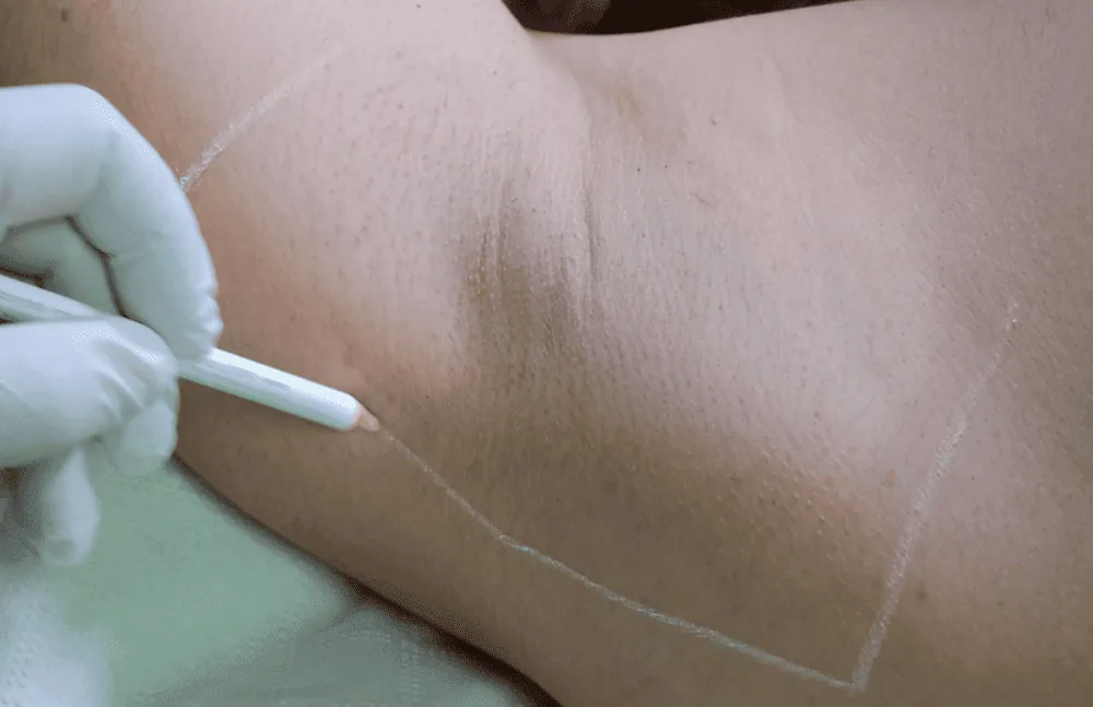 Markierung des Behandlungsbereichs mit einem weißen Stift
